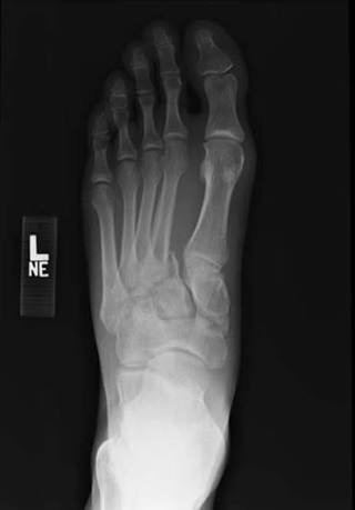 AP left foot X-ray after crush injury with inability to weight-bear.