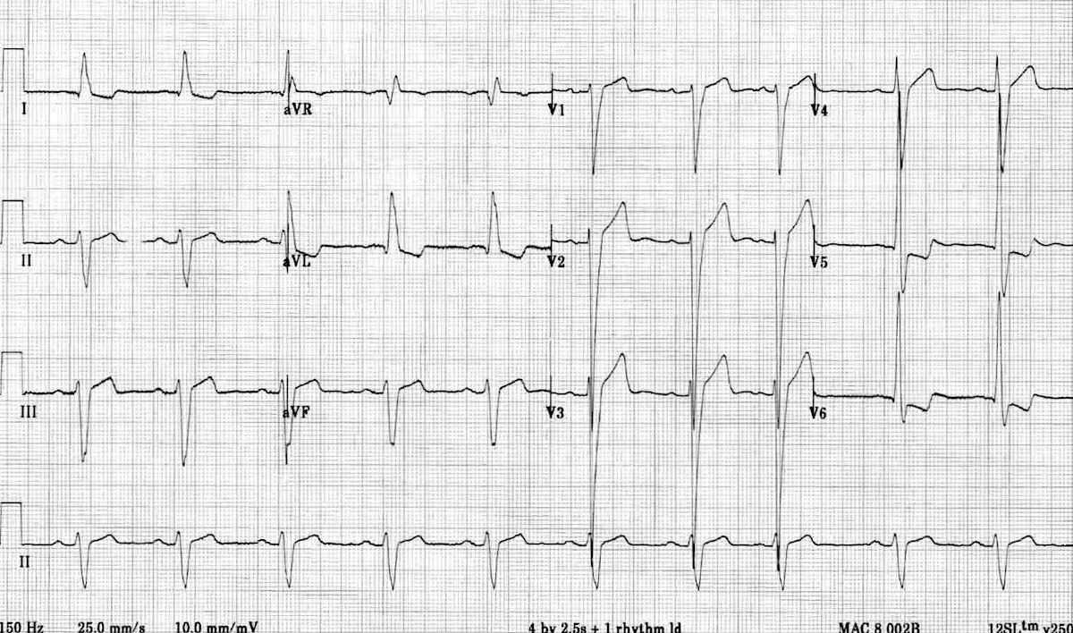 Twelve-lead ECG showing marked left-ventricular hypertrophy with strain features.