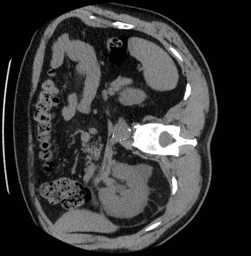 Axial CTKUB image showing right-sided renal tract abnormalities.