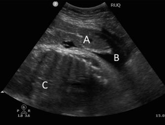 Right upper quadrant ultrasound image labelled A, B, and C.