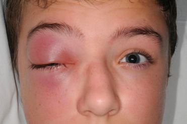 Clinical photograph showing marked right periorbital swelling and erythema.