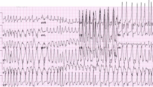 Twelve-lead ECG showing a wide-complex tachyarrhythmia.