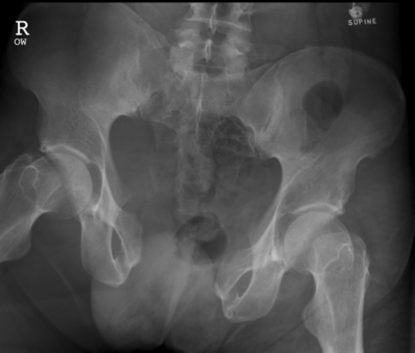 Pelvic X-ray showing an unstable pelvic ring injury.