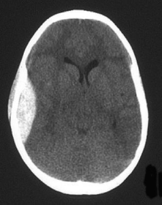 Axial CT brain image after paediatric head injury.