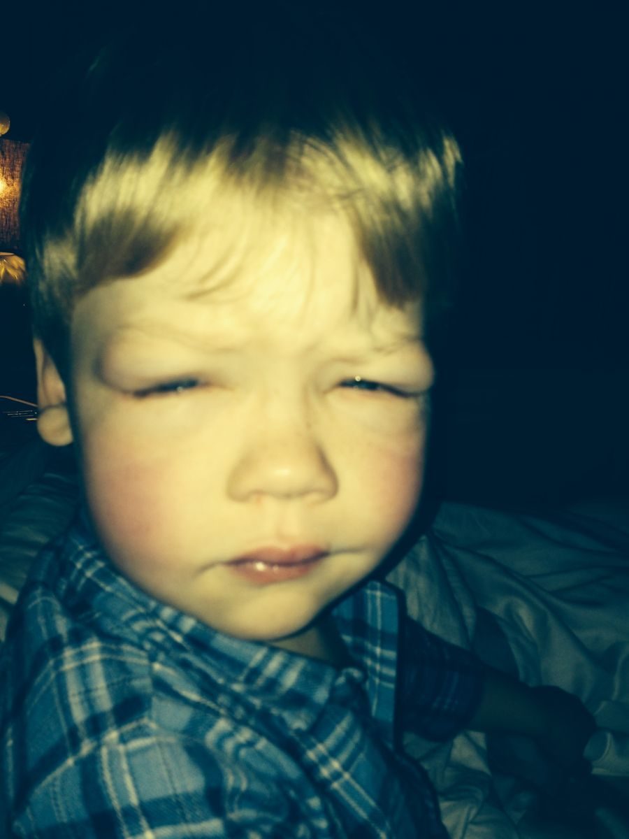 Clinical photograph showing facial and periorbital swelling in a child.