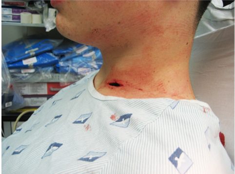 Clinical photograph showing an anterior neck stab wound.