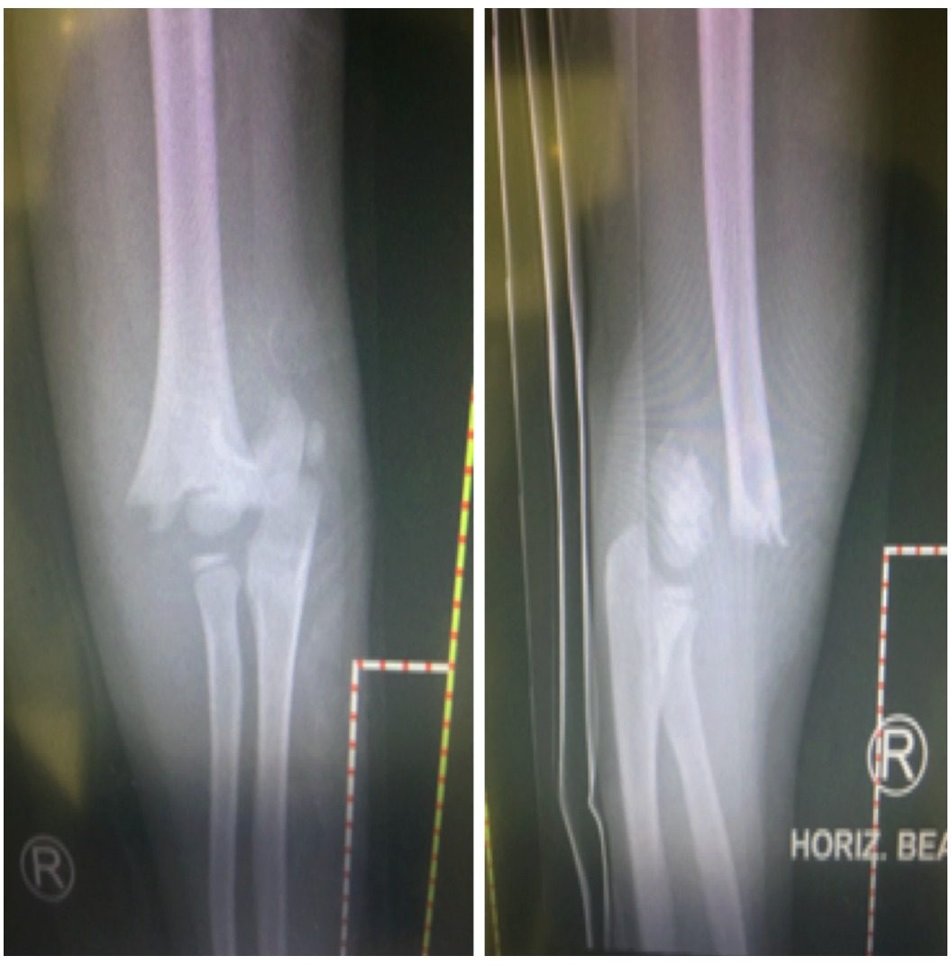 AP and lateral right elbow X-rays showing a paediatric supracondylar fracture.
