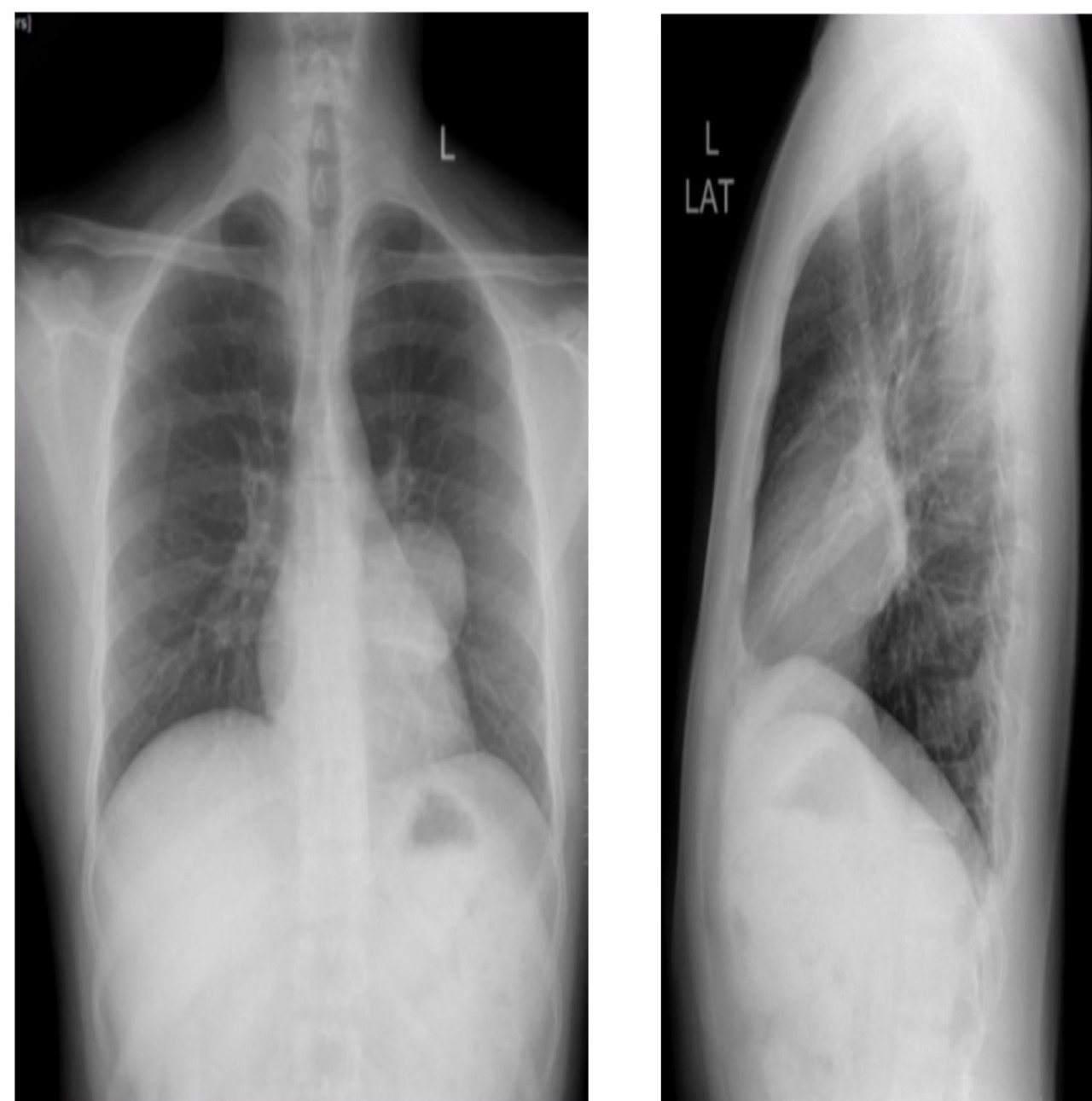 Chest X-ray showing a well-demarcated middle mediastinal mass.
