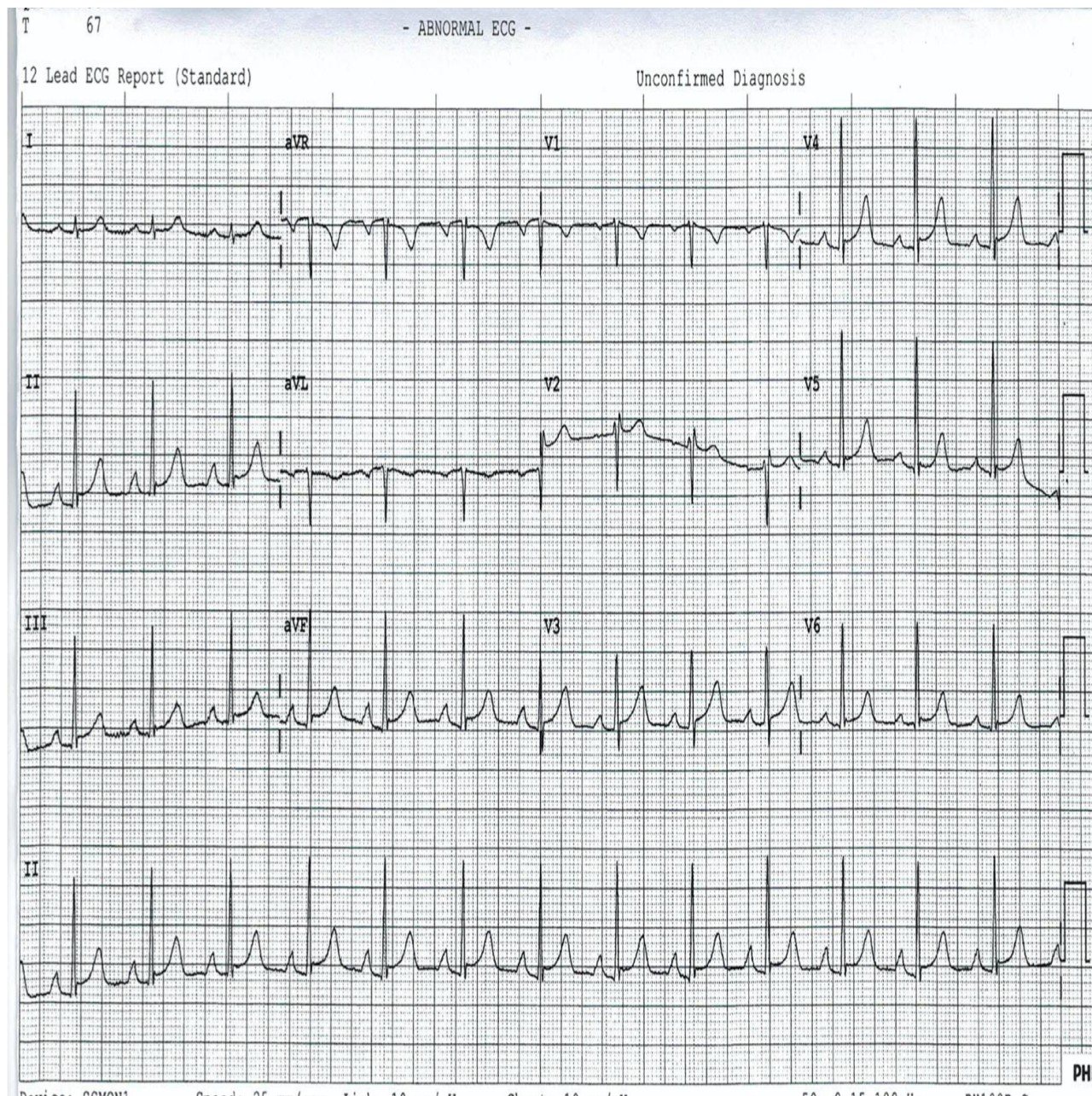 12-lead ECG showing PR depression and widespread changes consistent with pericarditis.
