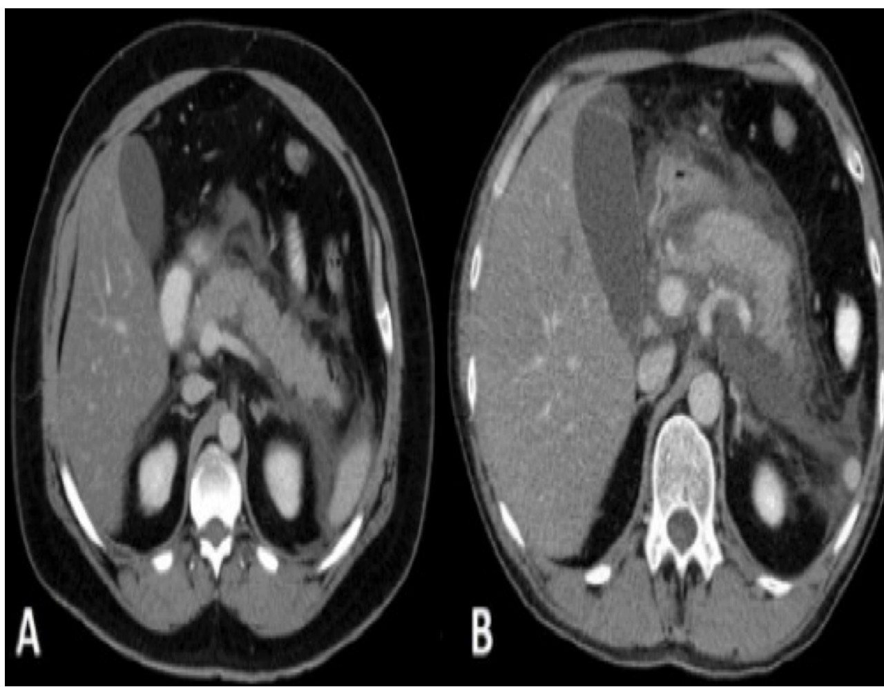 Two post-contrast CT abdomen axial slices.