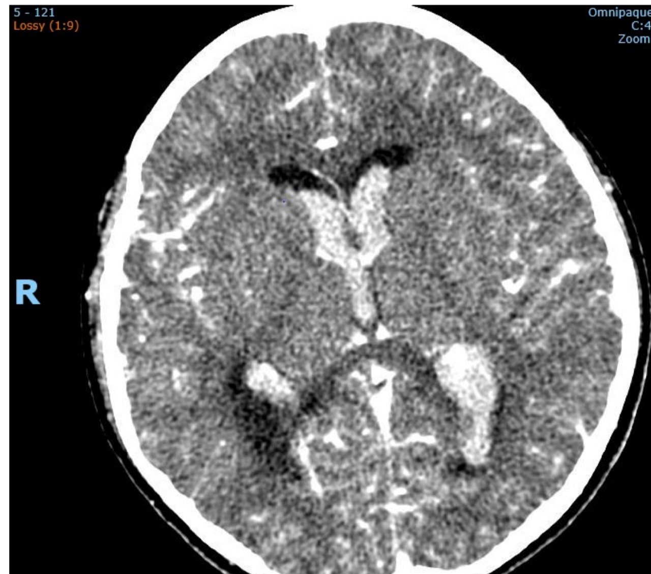 CT brain image from a collapsed intubated child.