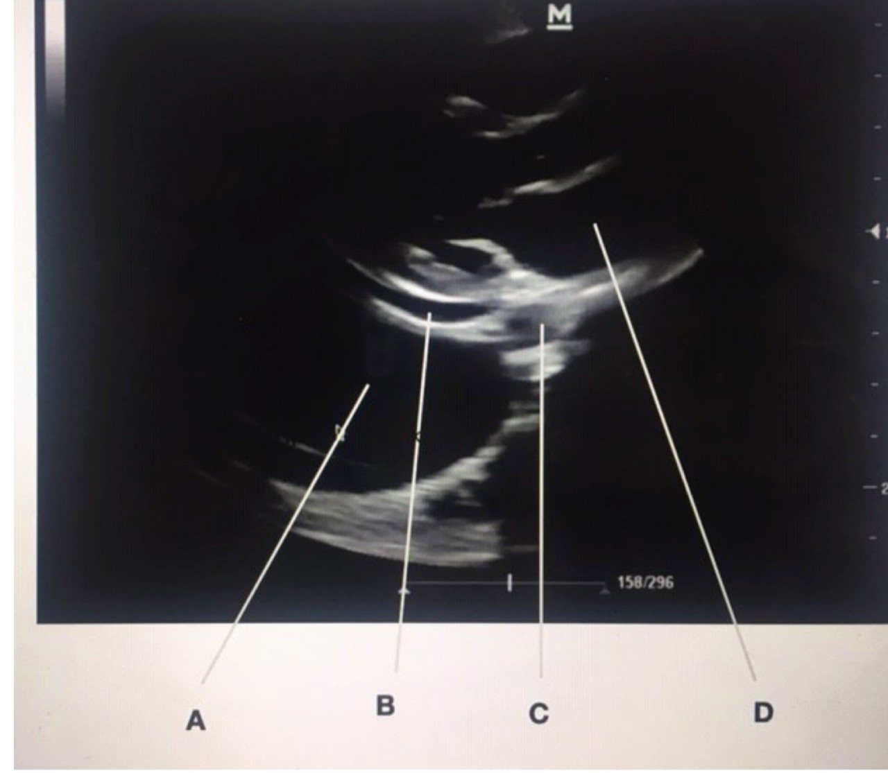eFAST parasternal long-axis cardiac ultrasound view with labels A to D.