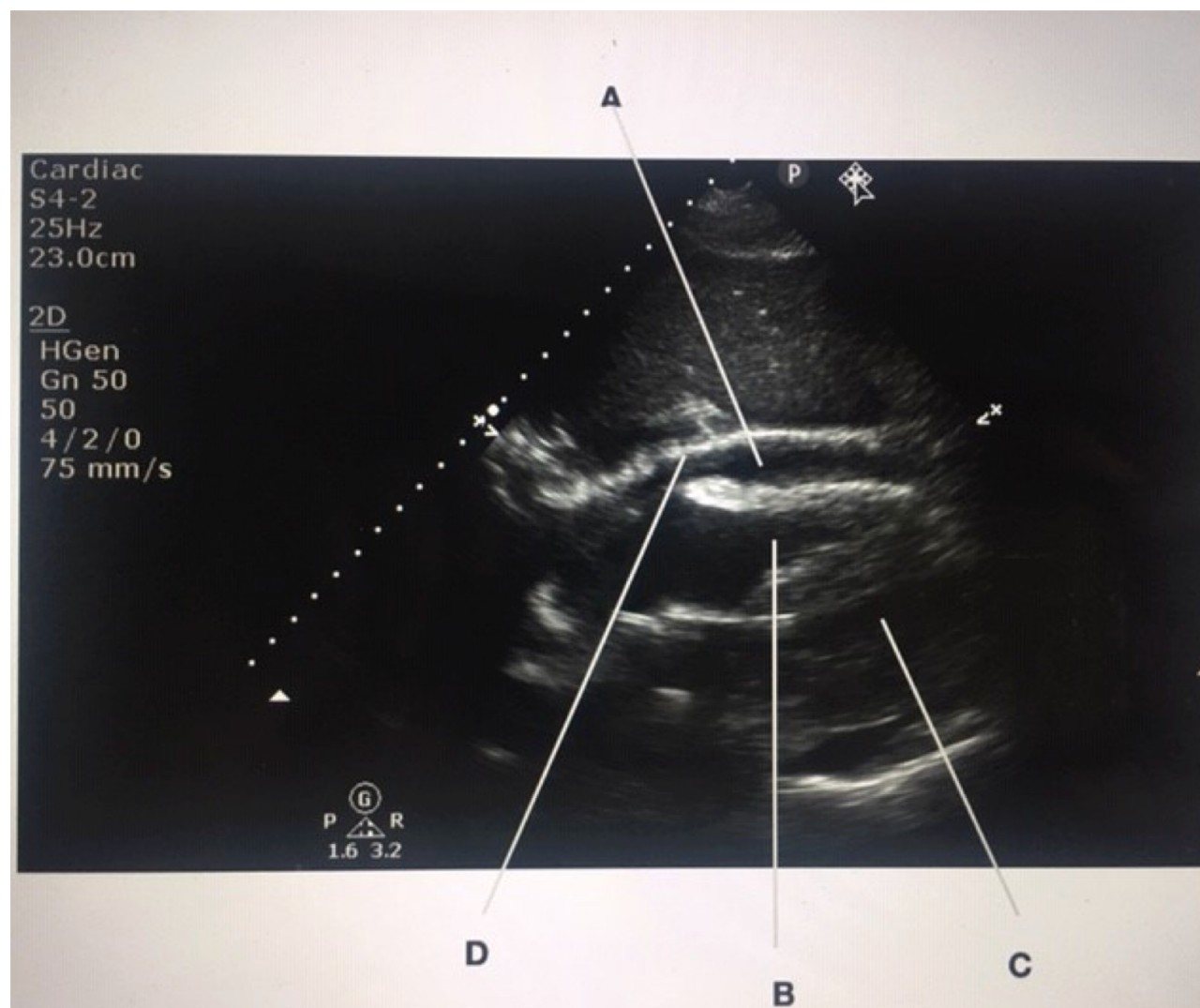 eFAST subcostal cardiac ultrasound view with labels A to D.