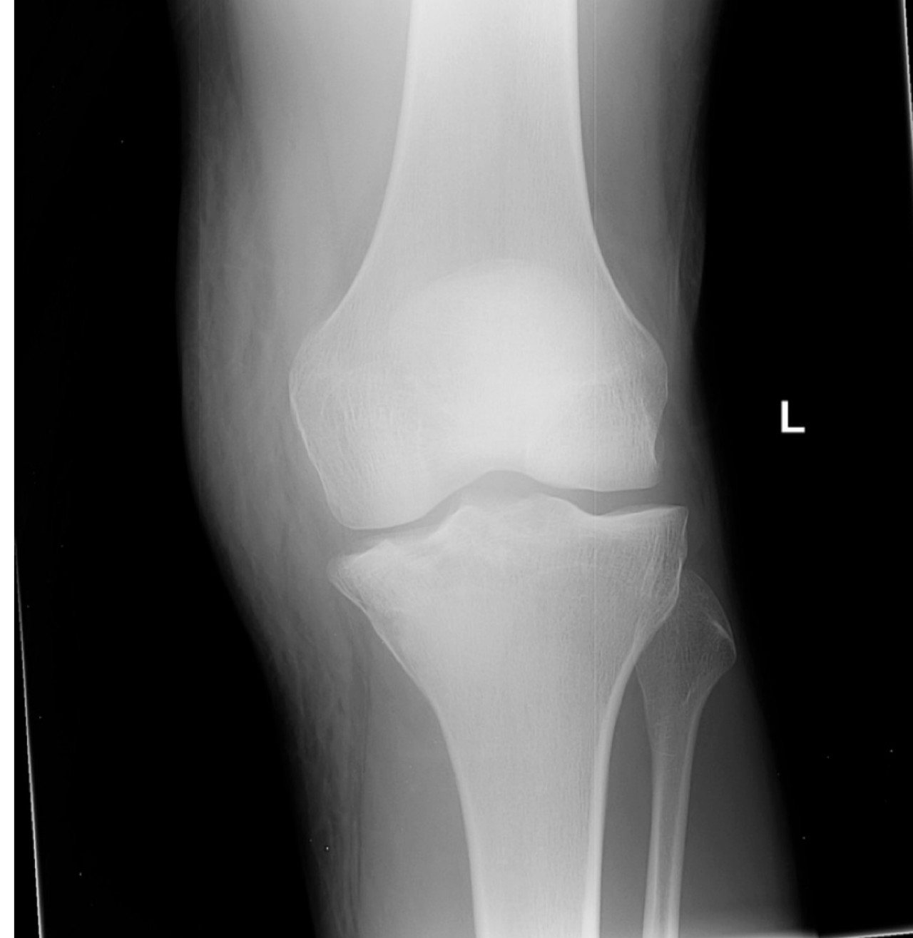 AP knee X-ray after a fall.
