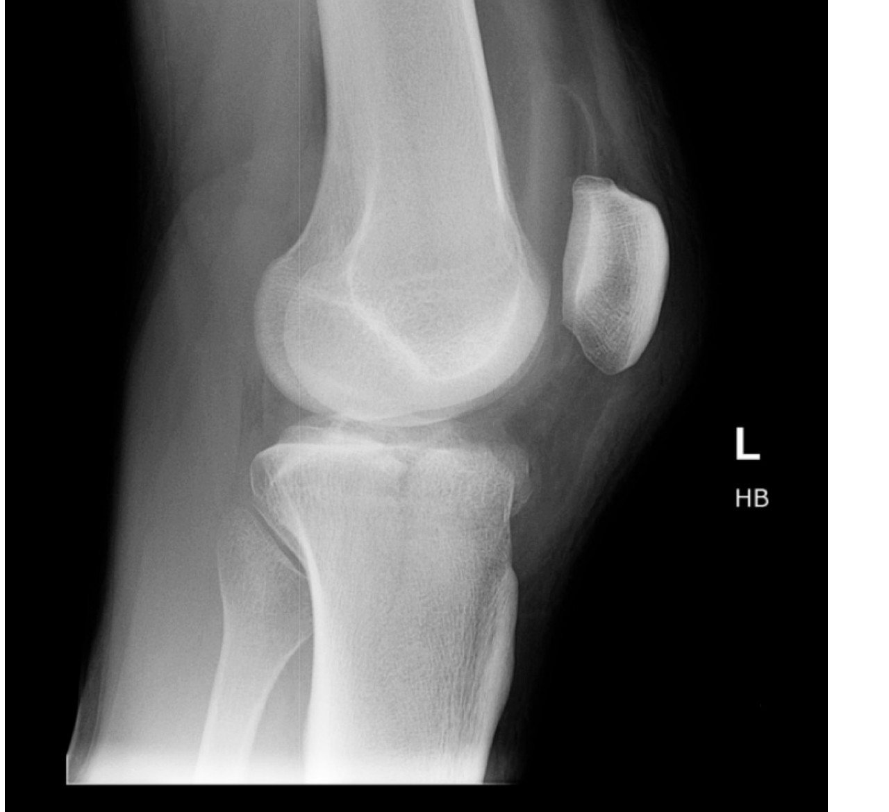 Lateral knee X-ray after a fall.