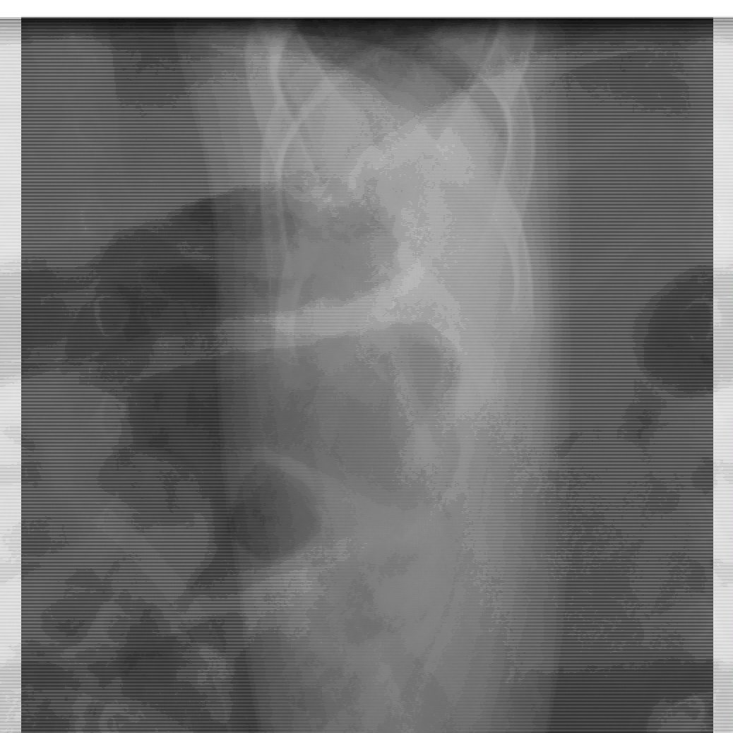 Abdominal X-ray of an infant with intermittent abdominal pain and vomiting.