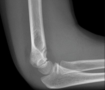 Lateral right elbow X-ray after a fall from monkey bars.