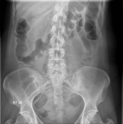 Abdominal X-ray in a patient with bloody diarrhoea and suspected colitis.