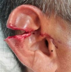 Right ear full-thickness laceration after a fall onto corrugated iron.