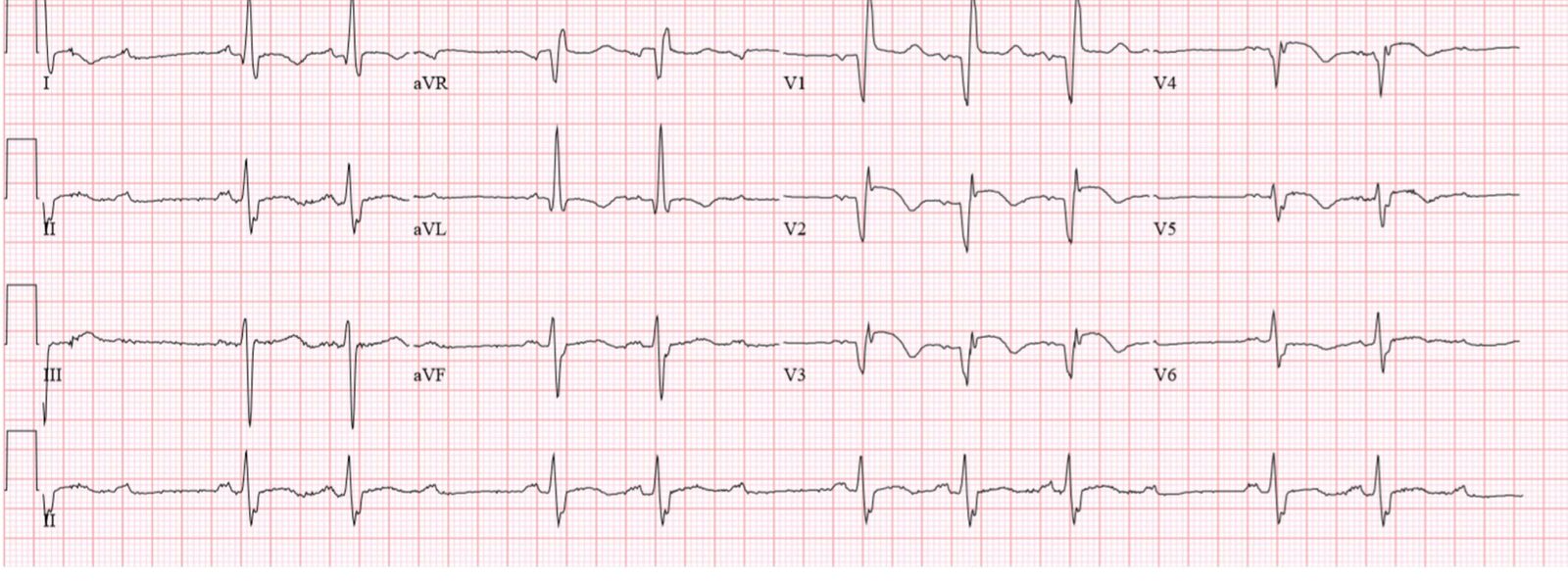 ECG in a patient with syncope and central chest discomfort.
