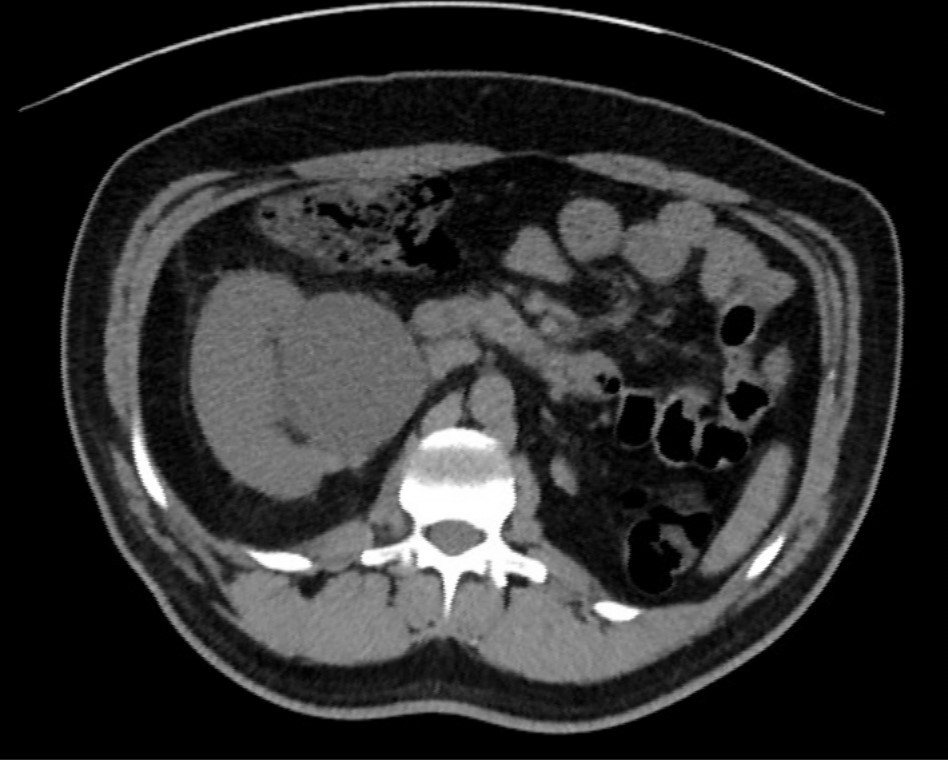 Axial CT abdomen slice showing right-sided urinary tract obstruction.