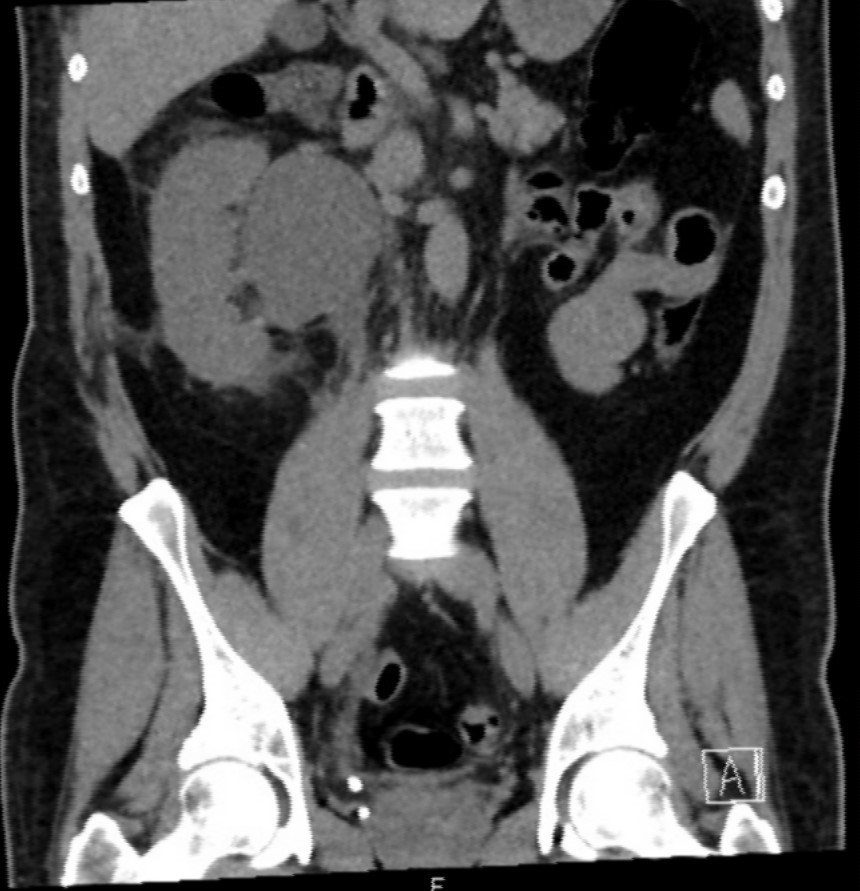 Coronal CT abdomen slice showing right hydronephrosis and distal ureteric stone.