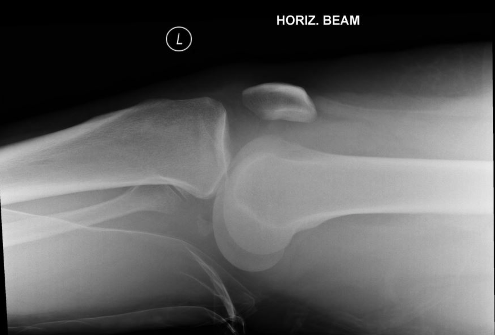 Horizontal-beam lateral left knee x-ray showing femorotibial dislocation.