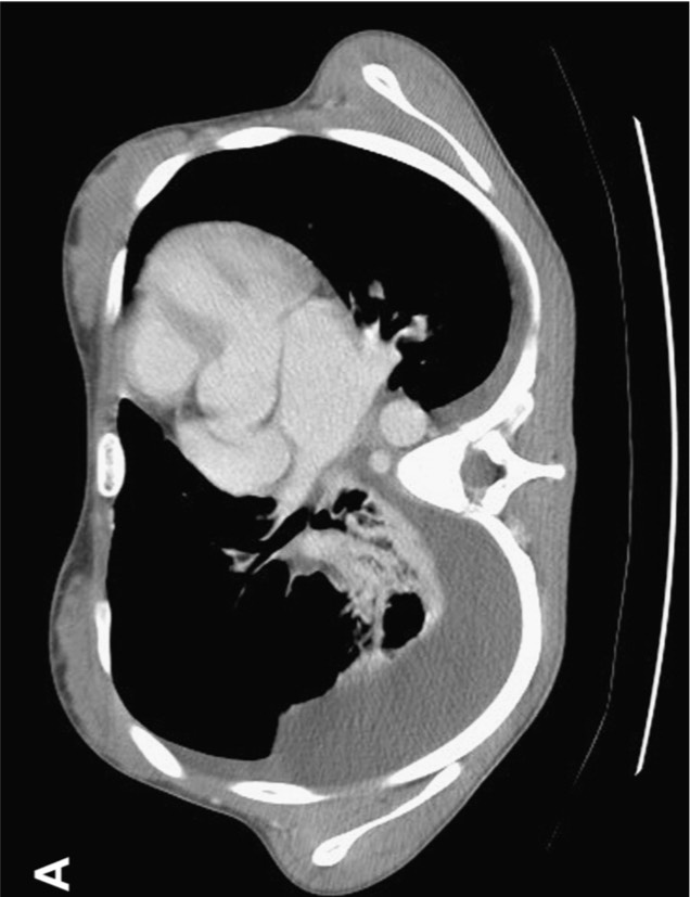 Contrast CT image showing pelvic mass, ascites and thoracic/abdominal findings.