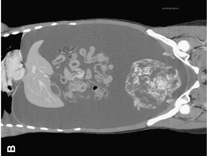 Second contrast CT image showing pelvic mass and ascites.