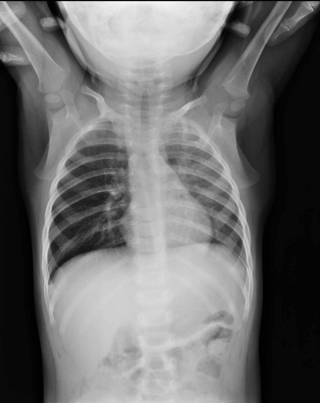 Paediatric chest x-ray showing right-sided hyperinflation and mediastinal shift.