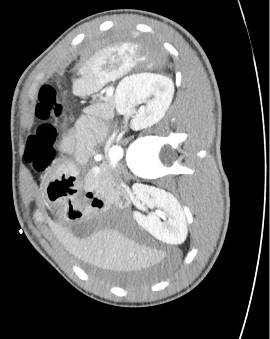 Abdominal CT slice showing high-grade splenic injury and intra-abdominal fluid.
