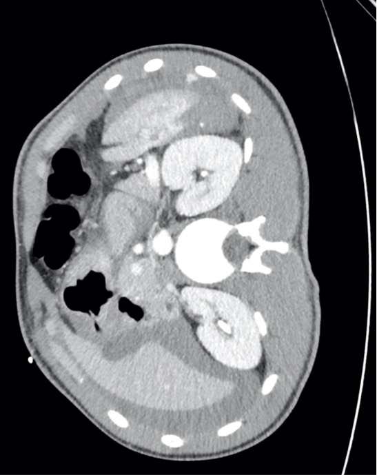 Second abdominal CT slice showing high-grade splenic injury and intra-abdominal fluid.