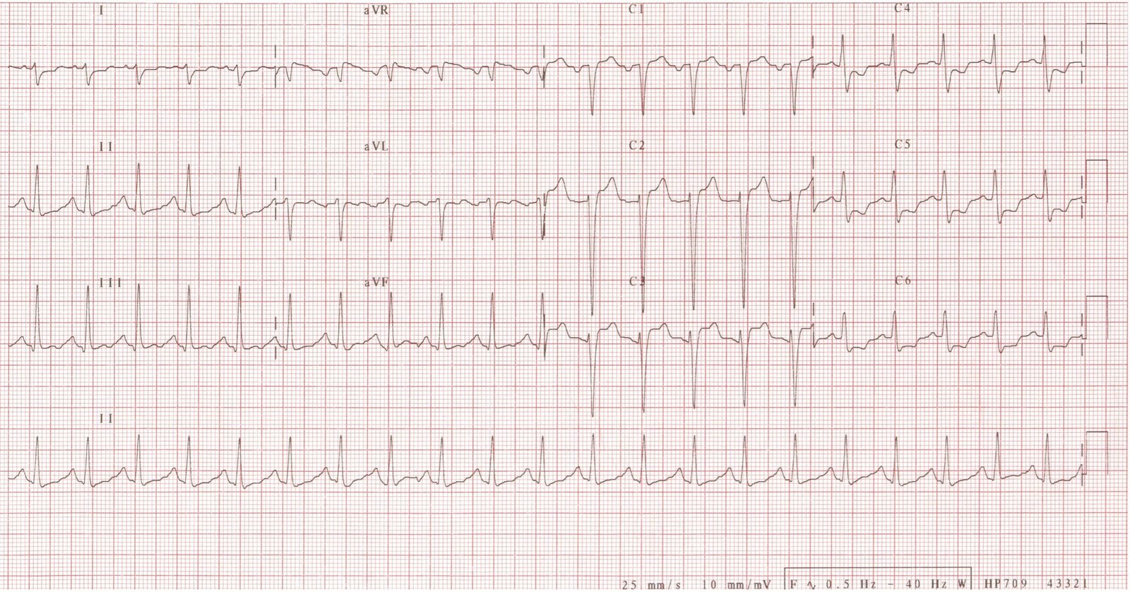 ECG showing anteroseptal STEMI with reciprocal ST depression and tachycardia.