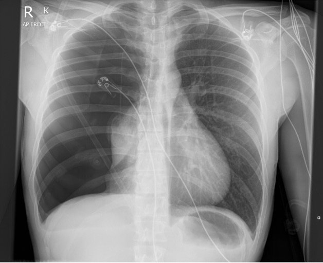 Chest x-ray showing a large right-sided pneumothorax with mediastinal shift.
