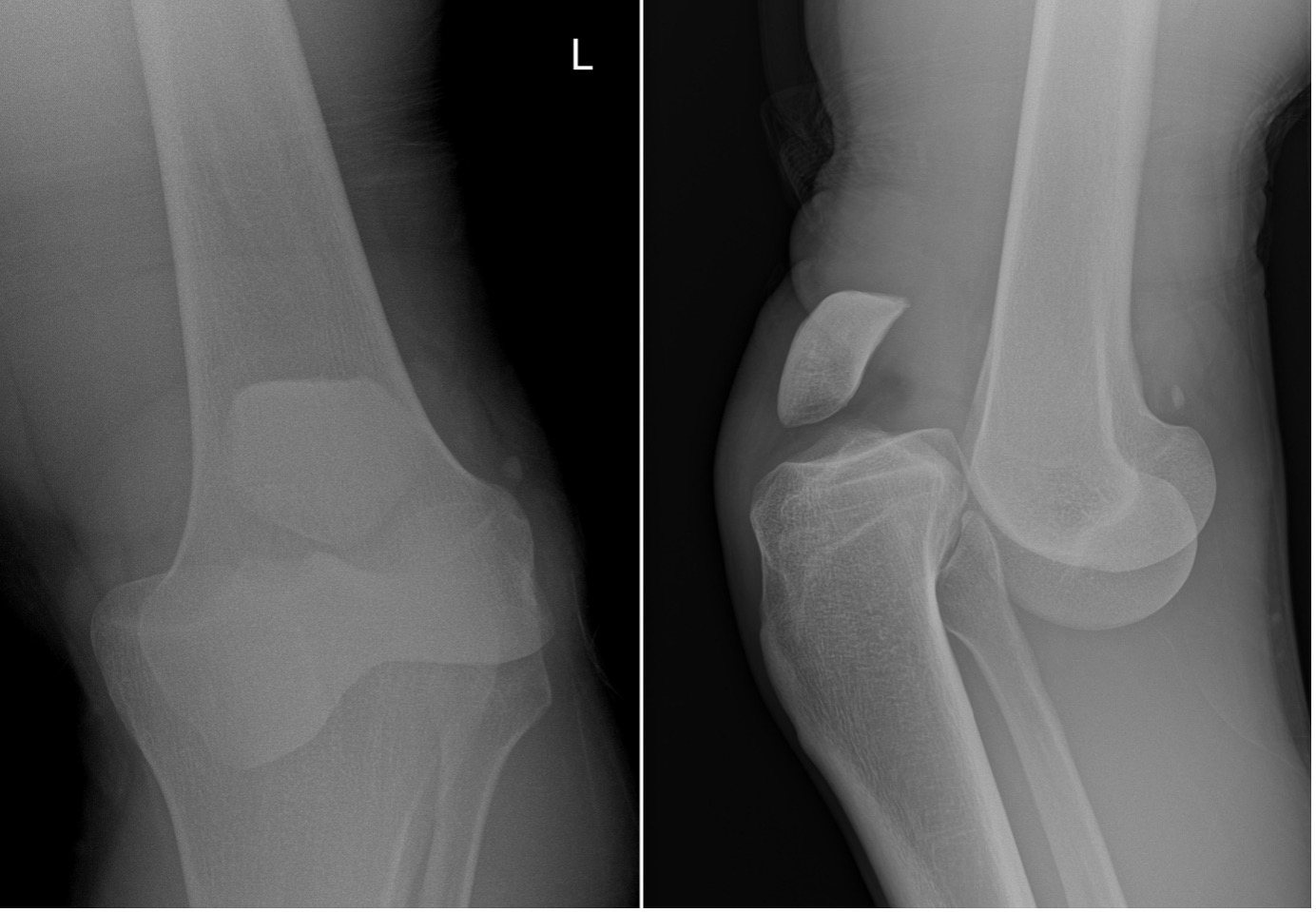 Knee x-ray showing anterior knee dislocation.