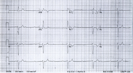 Initial ECG from a hypotensive patient with syncope and bradyarrhythmia.