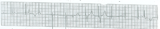 Rhythm strip after initiation of transcutaneous pacing.