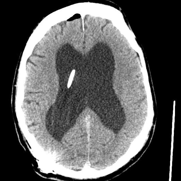 Non-contrast CT brain showing ventriculomegaly and ventricular shunt hardware.