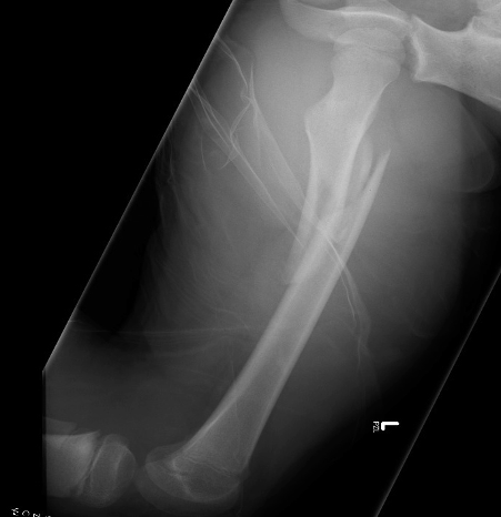Left femur x-ray showing a comminuted midshaft femoral fracture.