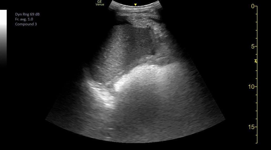 Right upper quadrant FAST ultrasound image in a trauma patient.