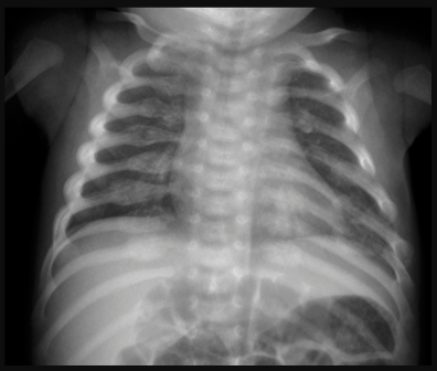 Chest x-ray of an infant showing multiple healing rib fractures.
