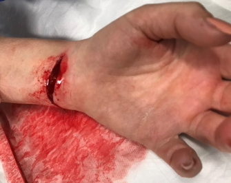Forearm laceration near the wrist.