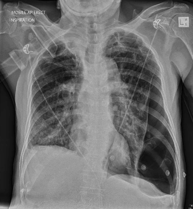 Portable chest x-ray showing left-sided bullous disease and loculated pneumothorax.