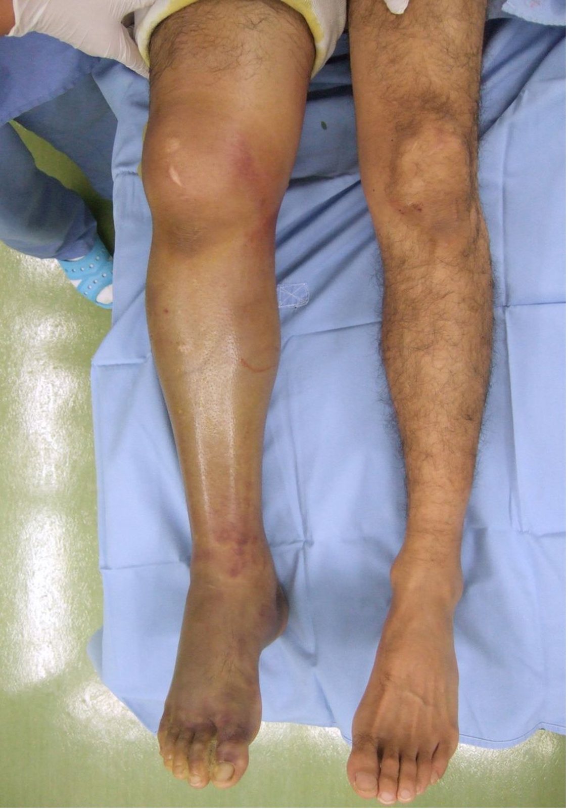Clinical photograph showing marked right lower-leg swelling and foot discolouration.