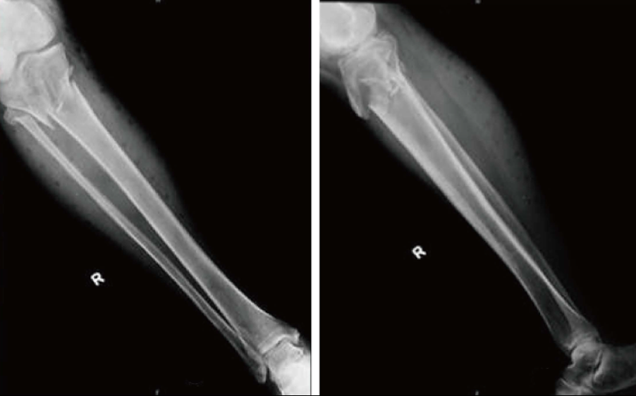 Right tibia and fibula x-rays showing proximal tibial and fibular fractures.