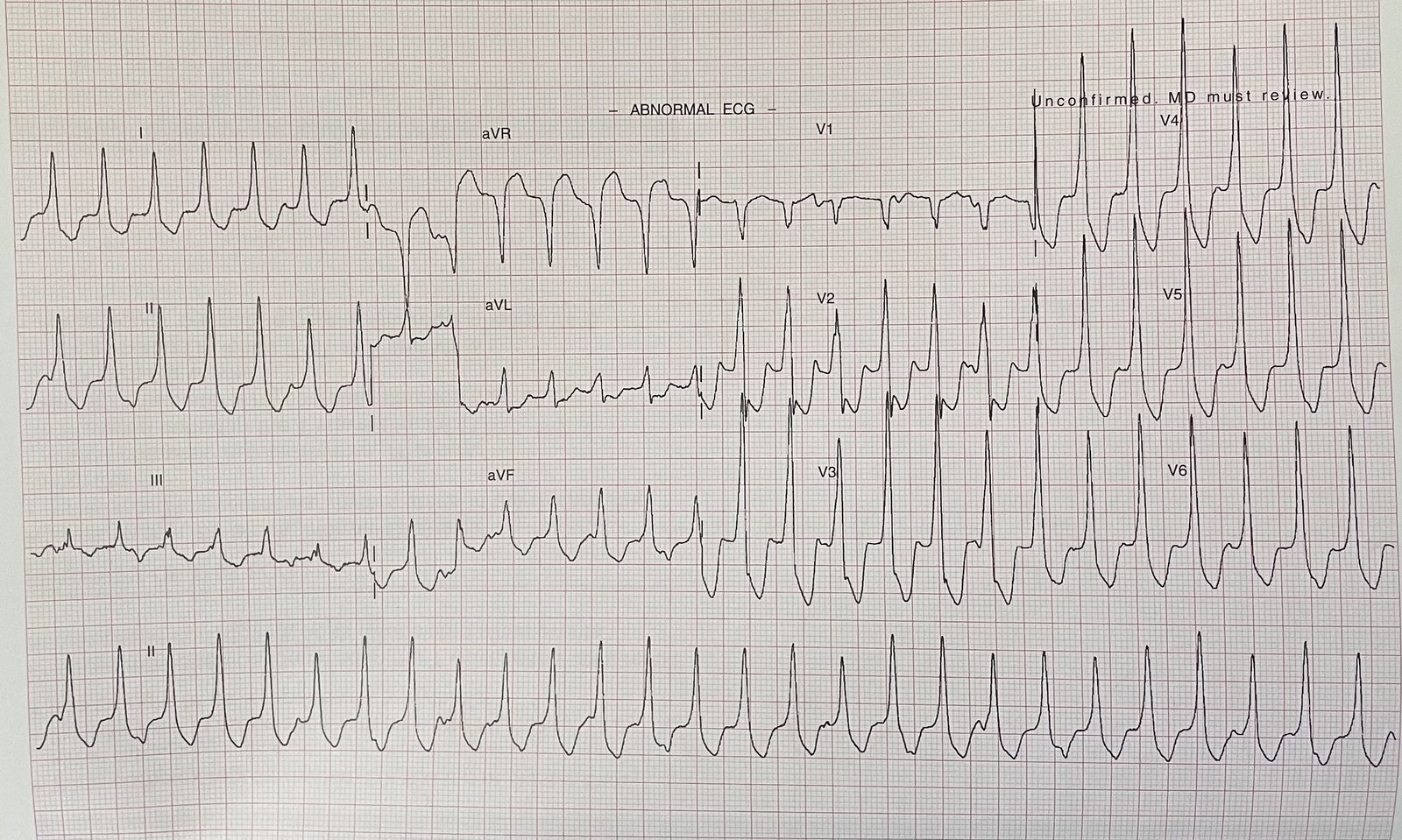 ECG showing a broad complex tachycardia.