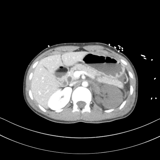 Axial CT abdomen image from blunt abdominal trauma.