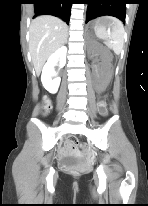 Coronal CT abdomen image from blunt abdominal trauma.