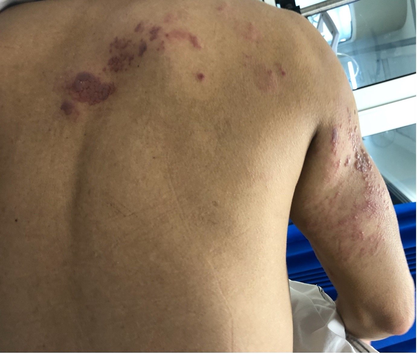 Clinical photograph showing vesicular/crusted rash over the back and arm.