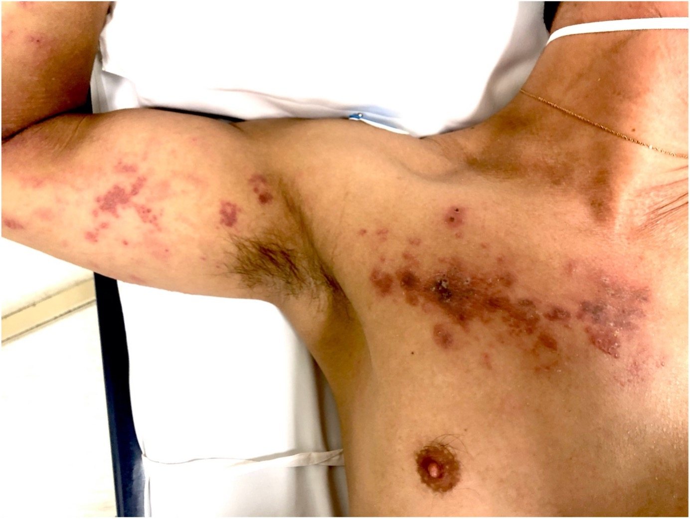 Clinical photograph showing vesicular/crusted rash across the chest and arm.